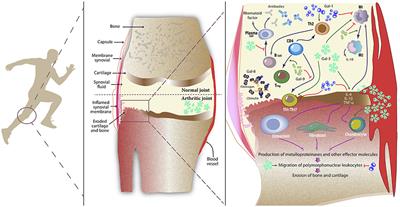 Clinical Relevance of Galectin-1 and Galectin-3 in Rheumatoid Arthritis Patients: Differential Regulation and Correlation With Disease Activity